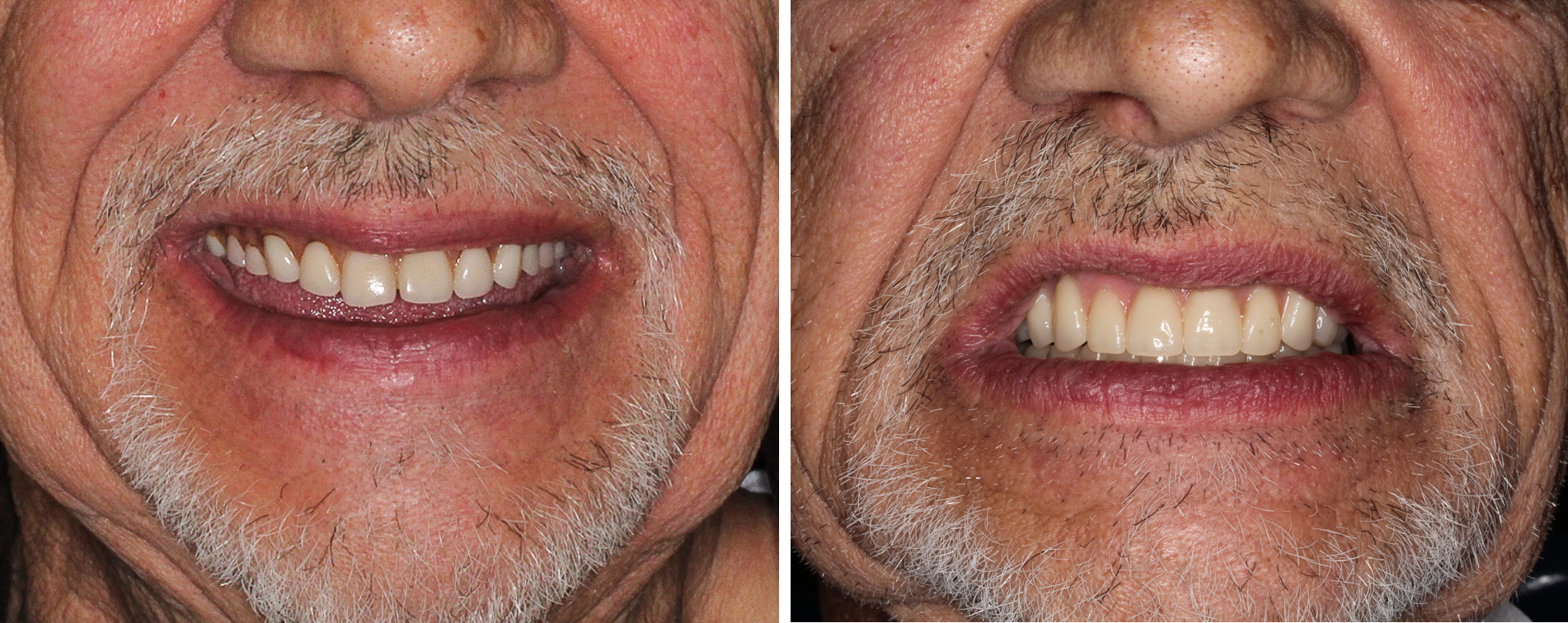 Implant Overdentures