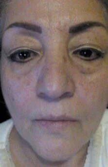 NuCerity Eye Effects 3 After Results in 3 Weeks 01