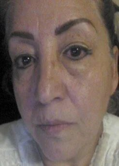 NuCerity Eye Effects 3 Before & After Results in 3 Weeks 02