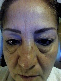 NuCerity Eye Effects 3 Before in 3 Weeks
