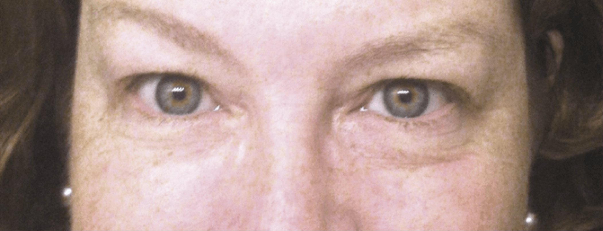 NuCerity Eye Effects 3 Before & After Results in 3 Weeks