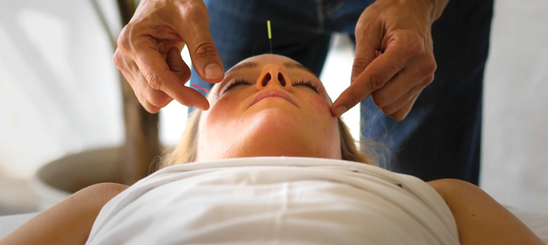 Acupuncture for Migraine_.jpg