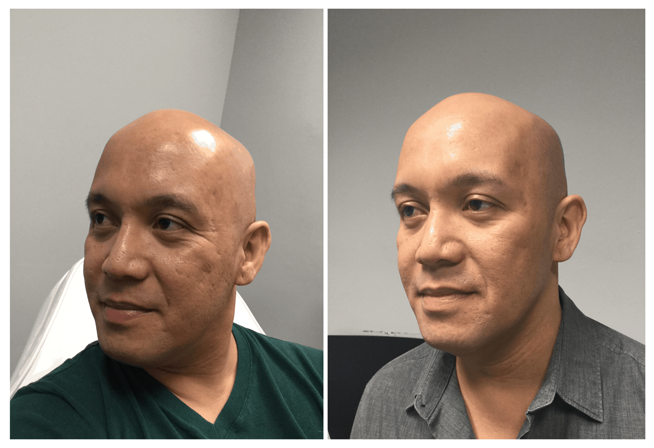 BeforeAfter_microneedling.png