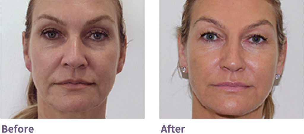 BeforeAfter_PDO_2-1024x453.jpg