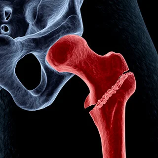 CS-Acetabular-Fracture.jpg