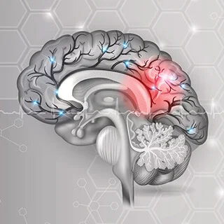 CS-Cerebrovascular-Accident.jpg