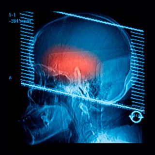 CS-Cerebellar-Atrophy.jpg