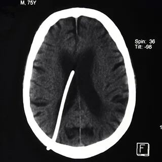 cs-normal-pressure-hydrocephalus.jpg
