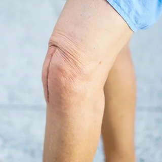 CS-Total-Knee-Arthroplasty.jpg