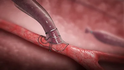 Laminate Medical Technologies’ VasQ device
