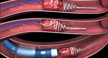 Illustration of Concentric MERCI retriever ensnaring a blood clot. Source: Society for NeuroInterventional Surgery