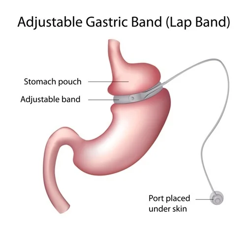 Lap Band.jpg