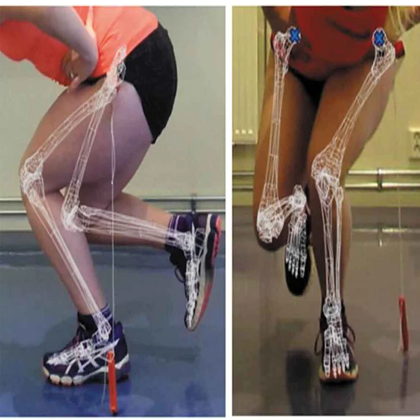 Knee position isn't a predictor of future ACL injuries, new study suggests