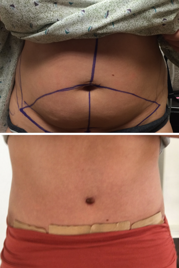 Tummy Tuck Blog Post