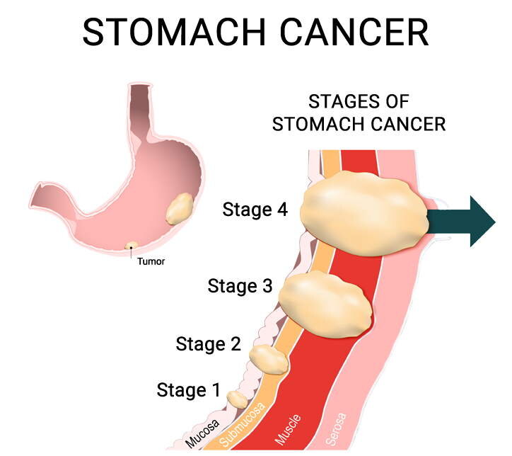 gastric cancer young adults