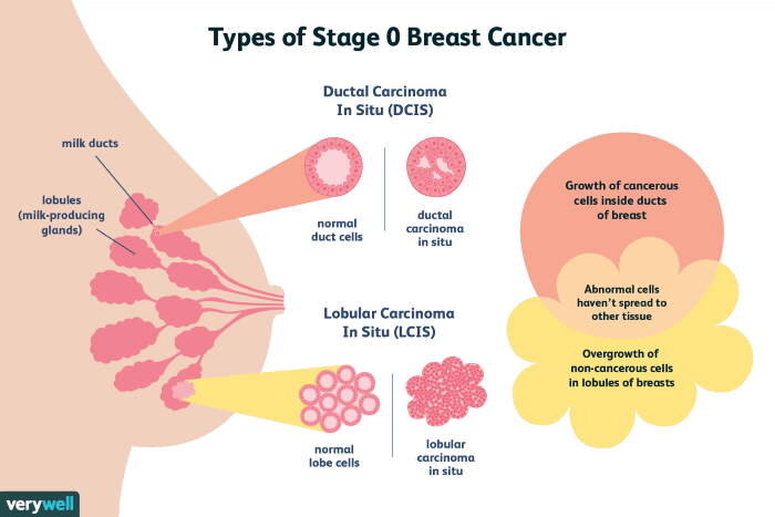 common presentation of breast cancer