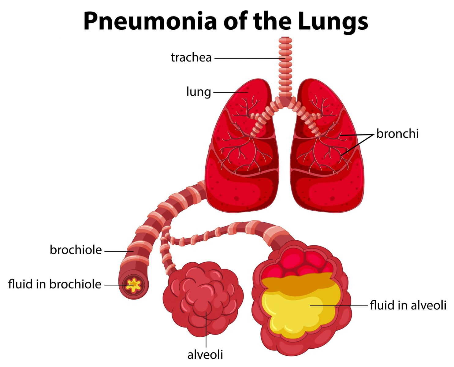 How Pneumonia Can Kill You & How to Prevent It Denver Concierge Medicine