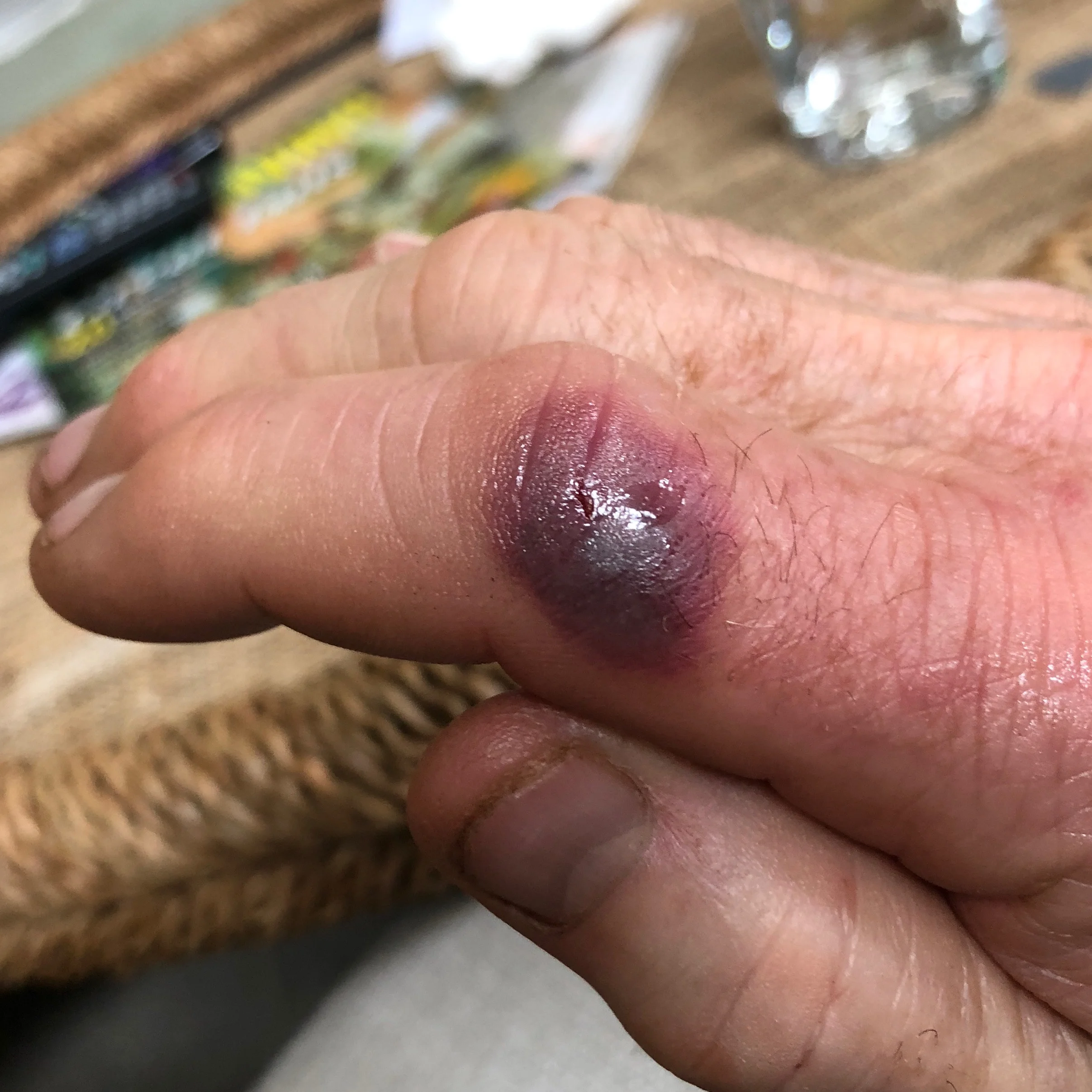 This is what my butt-ugly index finger looked like after it was snared by the teeth of the butt-ugly monk fish. Antibiotics were prescribed, but I was placed on sick-leave for 4 days.