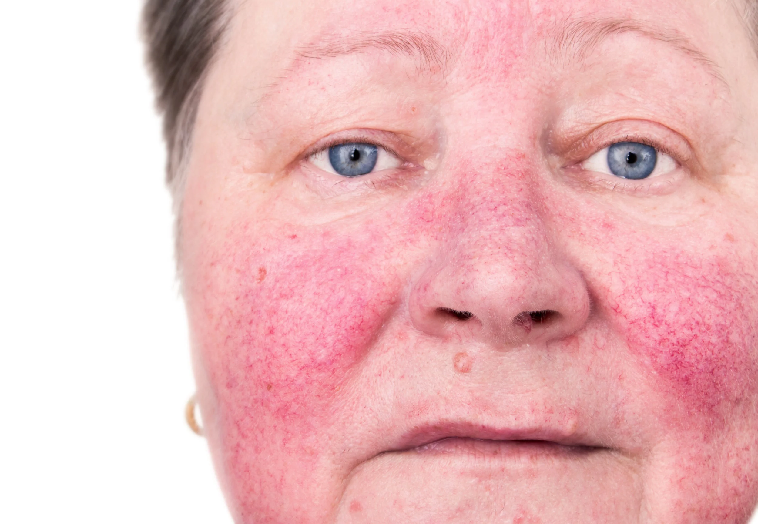 rosacea.jpeg