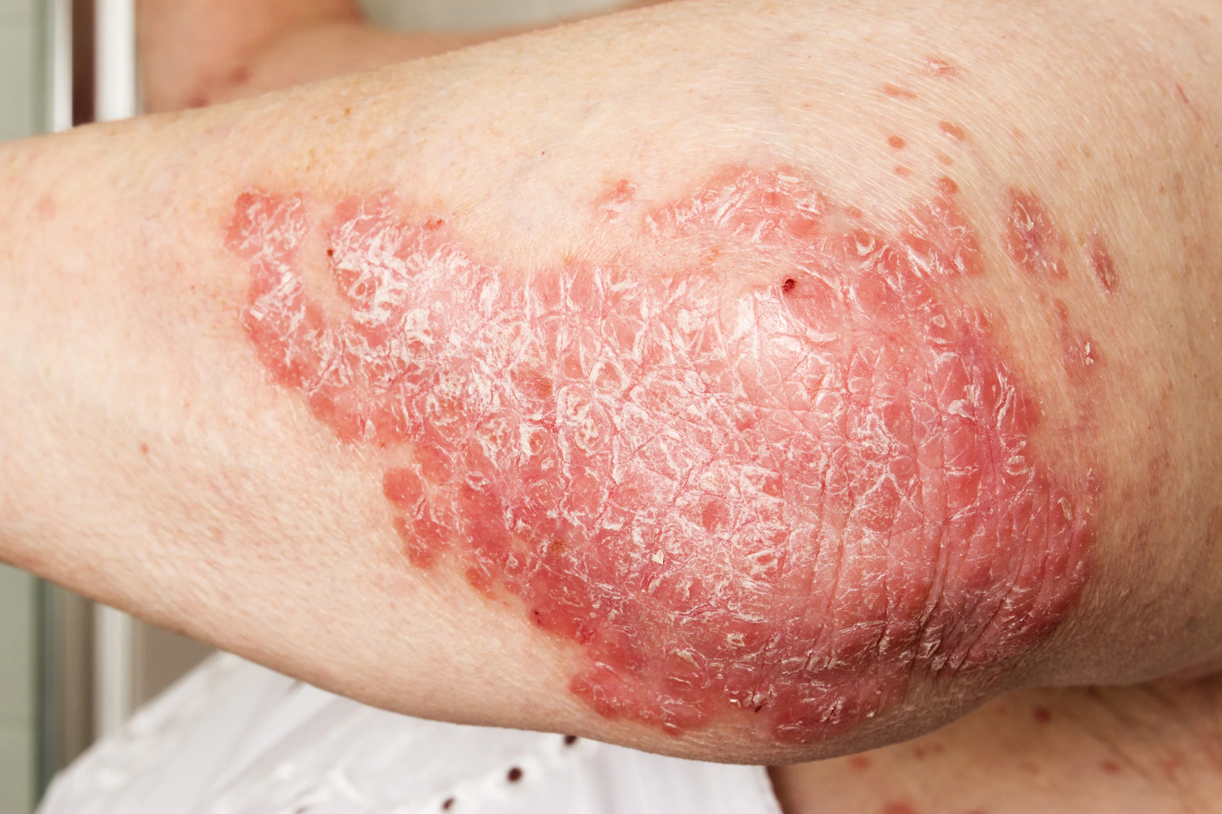 psoriasis.jpeg