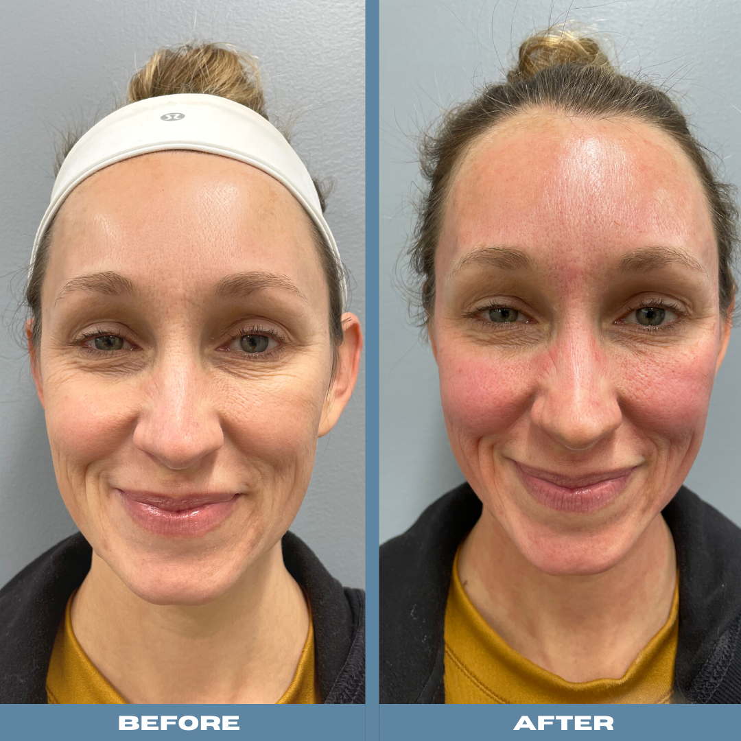 Microneedling Before After Photos Fresh Face Eye Hot Sex Picture 