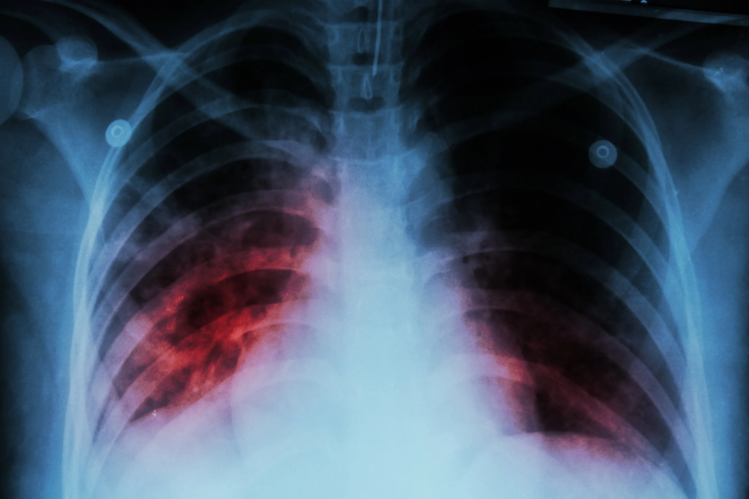 Pulmonary Tuberculosis ( TB )  :  Chest x-ray show alveolar infiltration at both lung due to mycobacterium tuberculosis infection