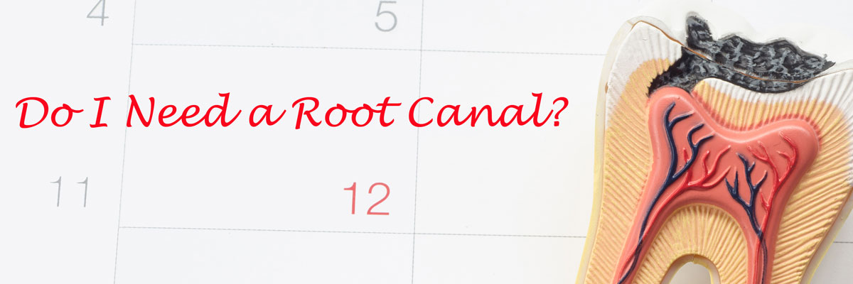 do-i-need-a-root-canal-header.jpg
