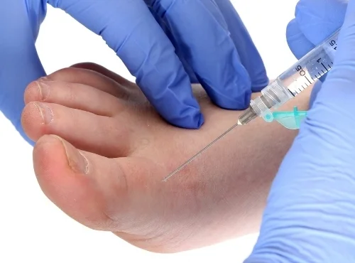 Nail Surgery Podiatry Partial Nail Avulsion