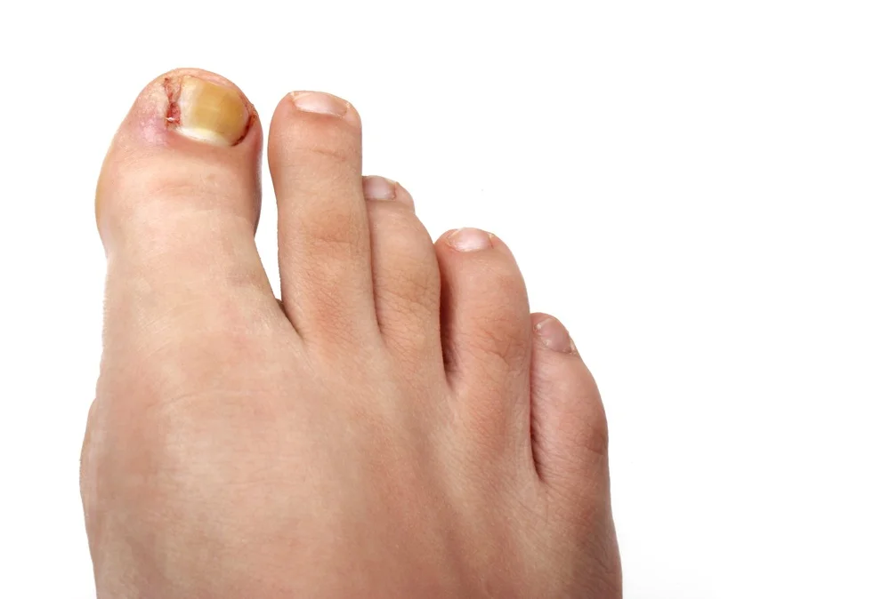 Podiatry Ingrown Nail Surgery