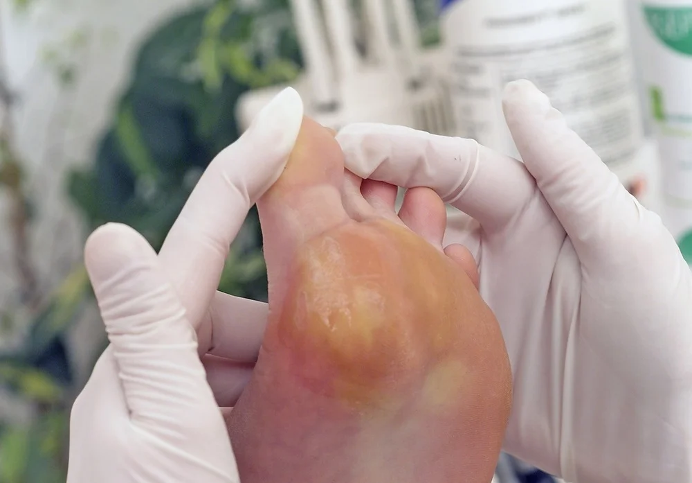 Corns and Callus