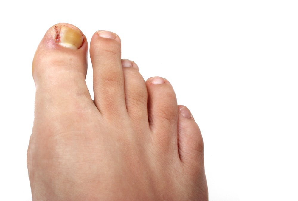 Does Ingrown Toenail Surgery Hurt? - Southern California Foot & Ankle  Specialists