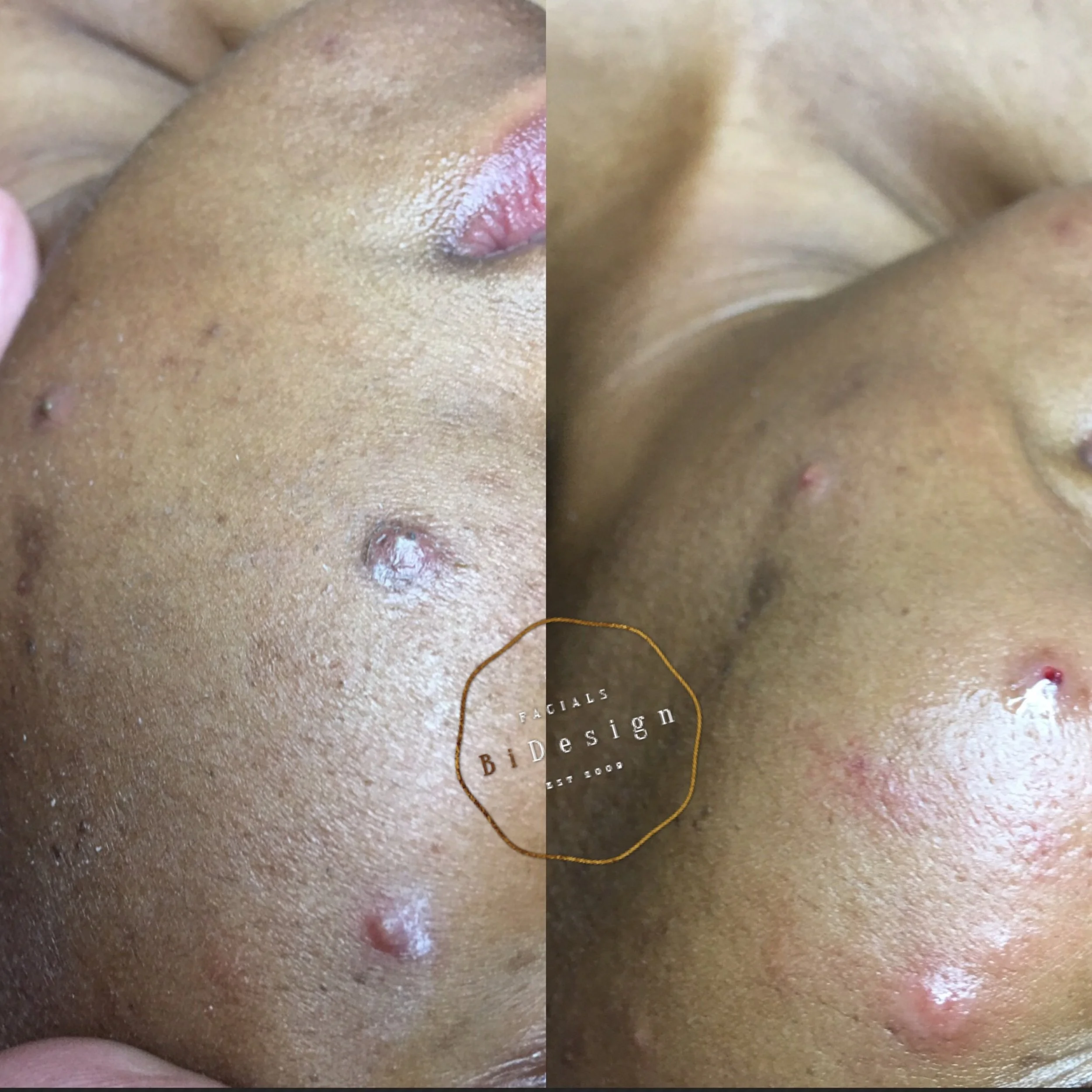 Severe Acne: A Problem With Mysterious Causes