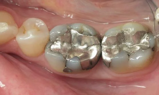Before: Failing amalgams and cracked teeth.