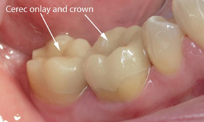 Cerec Onlay and Crown