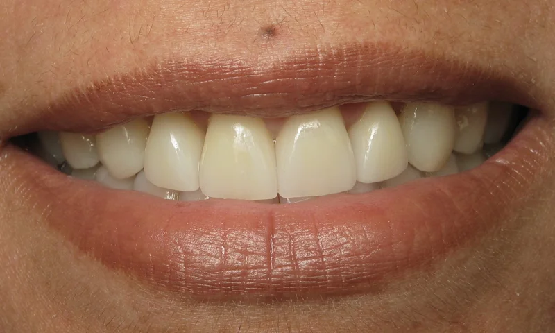 After: Periodontal surgery, 4 porcelain crowns and bonding.