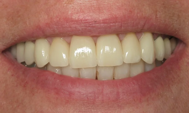 After: Porcelain crowns for the upper teeth and Cosmetic Braces for the lower incisors.