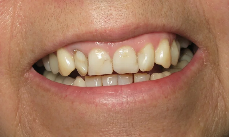 Before: Patient was unhappy about the appearance of her front teeth.