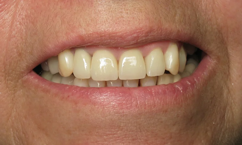 After: After 4 Porcelain Crowns.