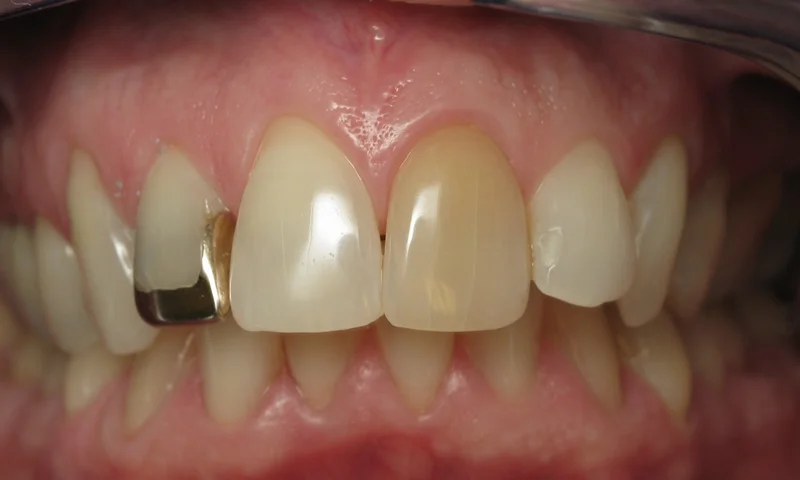 Before: Discoloration and 3/4 gold crown.