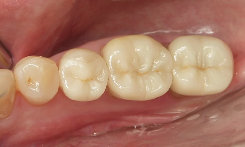 After: Porcelain onlays