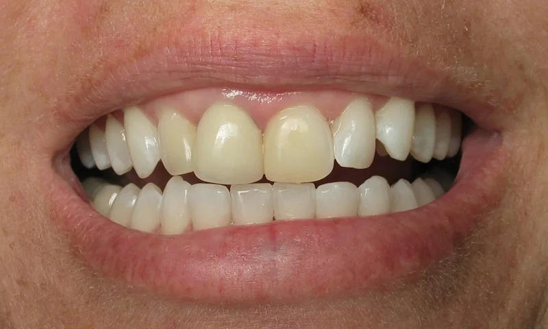 Before: Discolored, supraerupted and rotated teeth