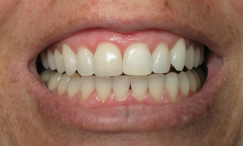 After: Adult Cosmetic Ortho, bleaching, and a new porcelain crown.