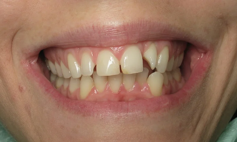 Before: Multiple cosmetic concerns with 4 months to fix them.