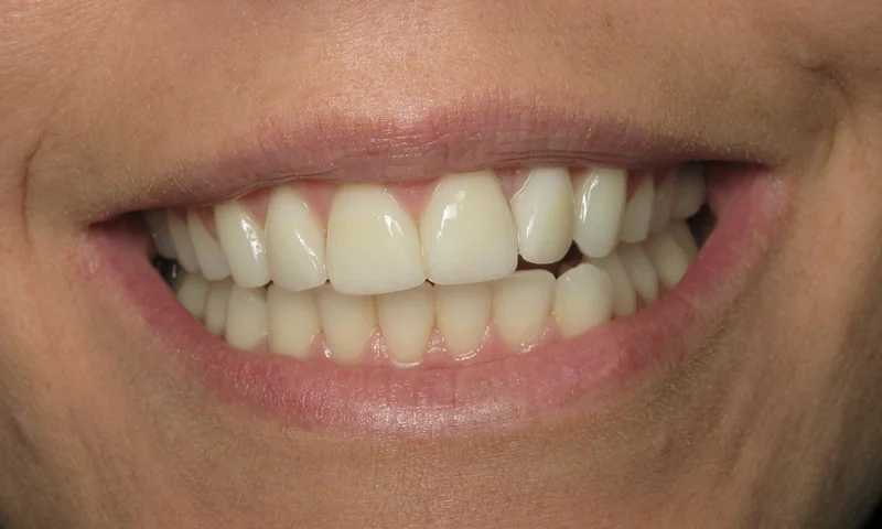 After: Cosmetic braces with 4 porcelain veneers. 4 month treatment time.