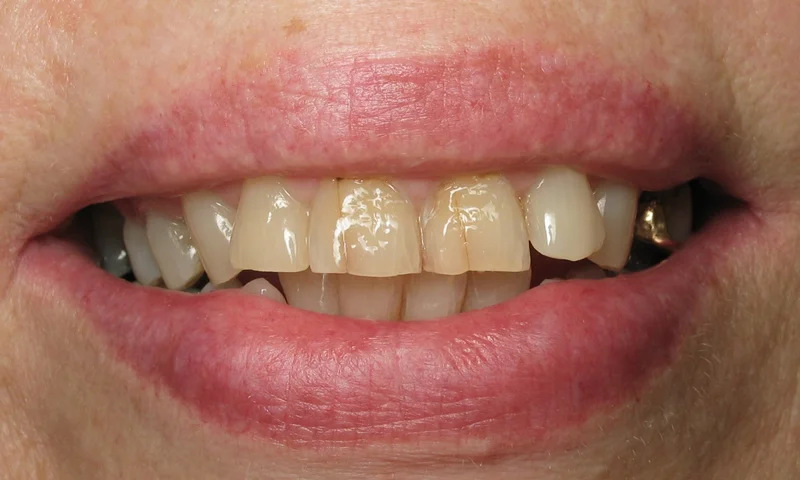 Before: Patient was very unhappy about her smile.