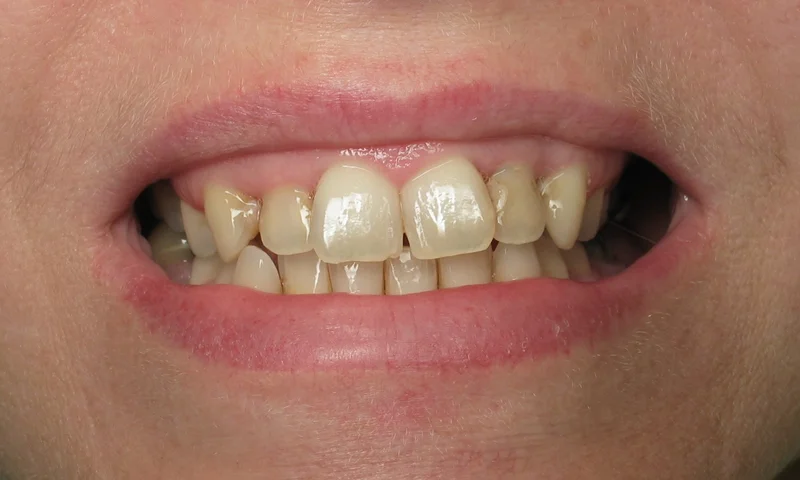Before: Multiple cosmetic concerns. Patient was not happy with her smile.