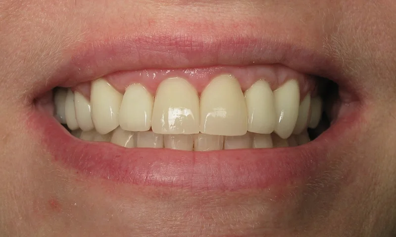 After: Cosmetic braces on the lower and porcelain crowns on the upper.