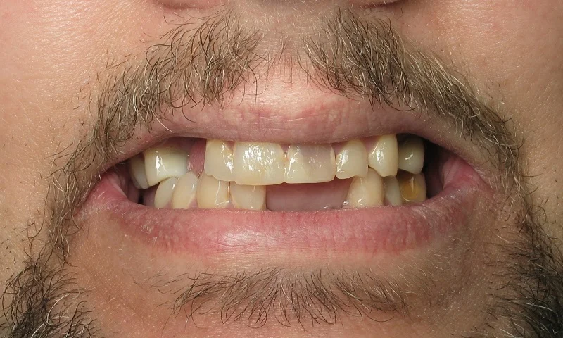 Before: Decay and Missing Teeth.