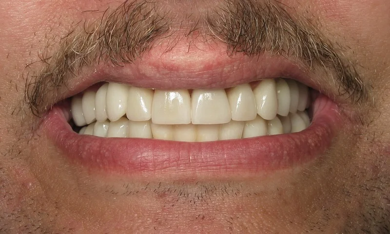 After: Multidisciplinary dentistry. Great new smile!
