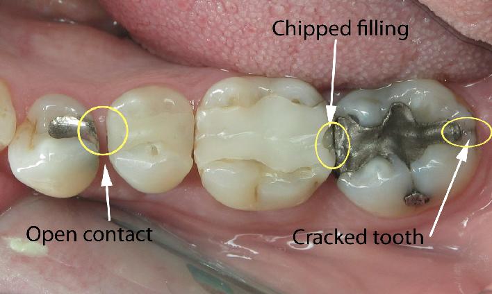 708_chipped filling open contact cracked tooth.jpg